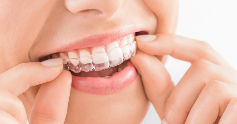 Invisalign can help with preventing cavities with braces