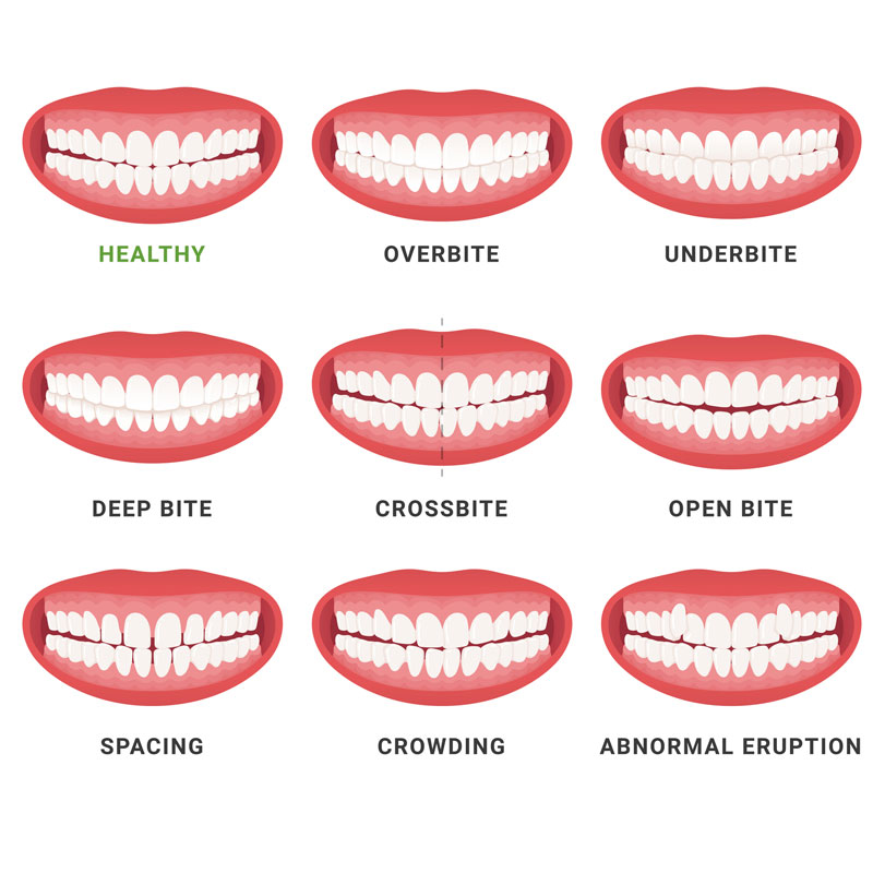 Dental Conditions That Often Require Braces 