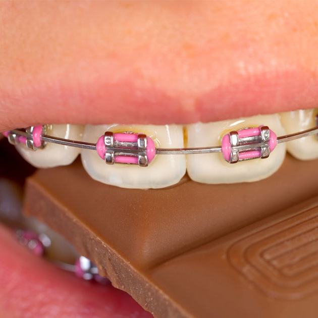 Candy and Braces