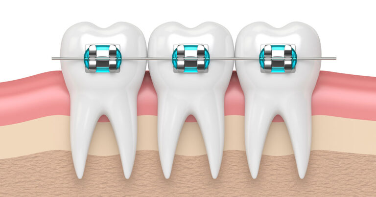 Different Types of Braces - Robison Orthodontics