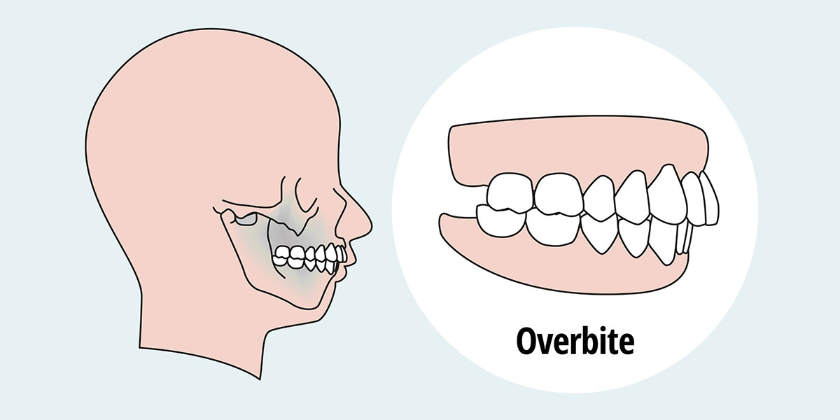 What Is an Overbite