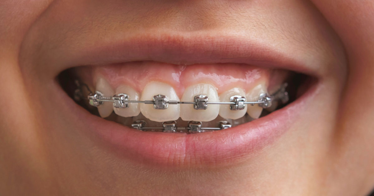 orthodontist invisible braces