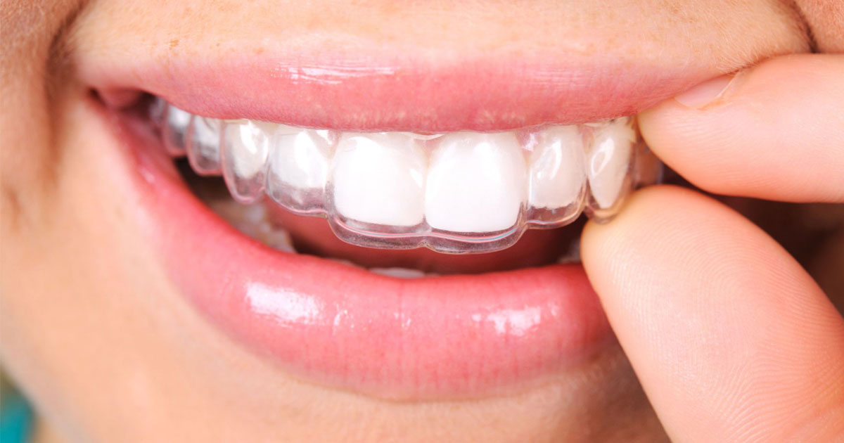 Why Consider Invisalign